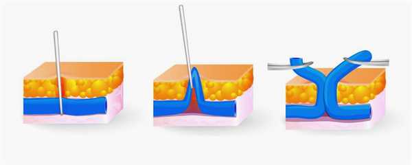 Минифлебэктомия варикозных вен