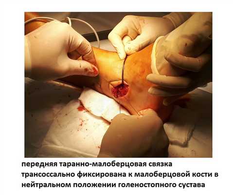 разрыв связок голеностопа операция