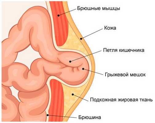 Состав грыжи