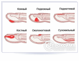 Виды панариций