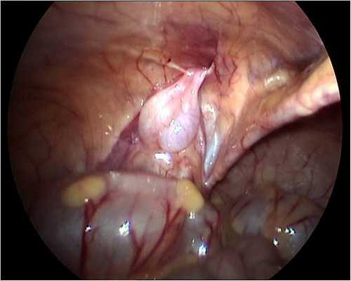 Крипторхизм у детей