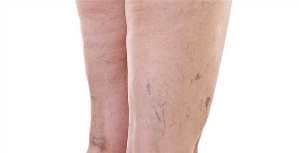 варикозное расширение вен