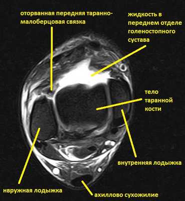 передняя таранно малоберцовая связка мрт