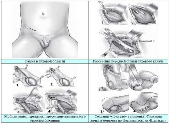 Оперативное лечение крипторхизма, фото