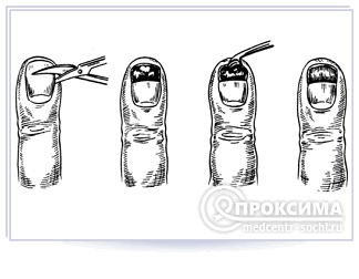 Вскрытие панариция