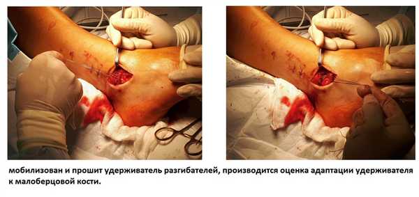 операция бростром