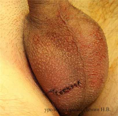 Яичко в мошонке, фото после операции