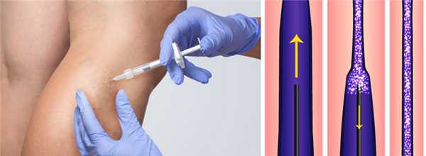 Склеротерапия вен фото