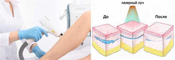 Удаление сосудистых сеточек лазером
