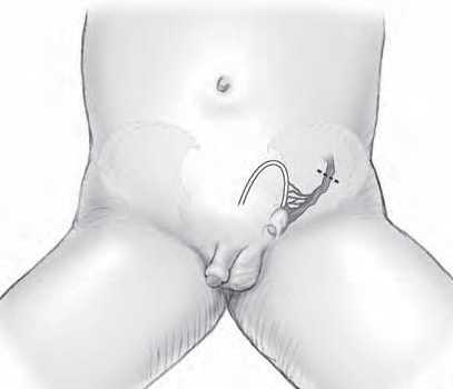 Пересечение тестикулярных сосудов, фото