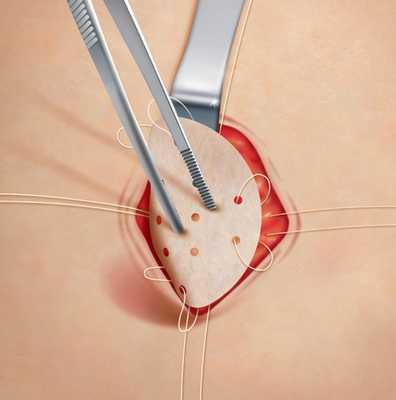 операция при вентральной грыже