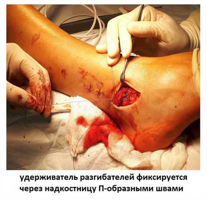 операция восстановления связок голеностопа