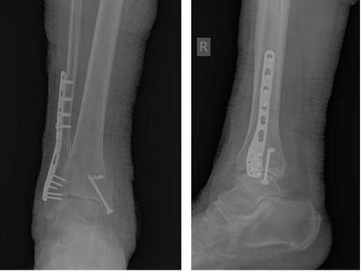 остеосинтез при переломе лодыжек