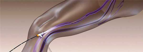 Радиочастотная облитерация и эндовенозная лазерная коагуляция подкожных вен