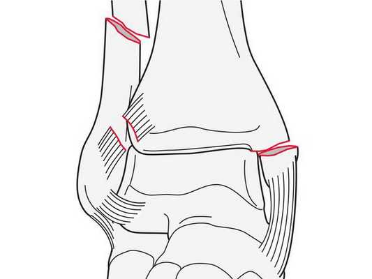 AO Classification 44C1.2 (простой перелом диафиза малоберцовой кости с переломом медиальной лодыжки)