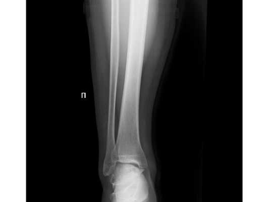 Первичная рентгенограмма в передне-задней проекции