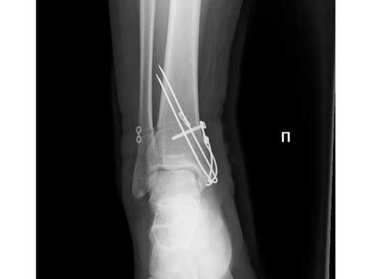Рентгенограмма после операции в передне-задней проекции
