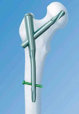 Остеосинтез гамма гвоздем