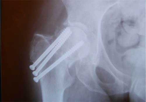 Остеосинтез ТБС на рентгене