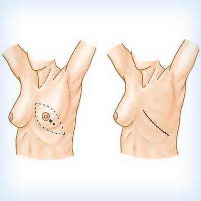 стоимость операции по удалению опухоли молочной железы