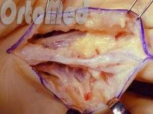 лечение с помощью опреации контрактуры Дюпюитрена