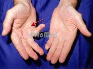 Болезнь дюпюитрена