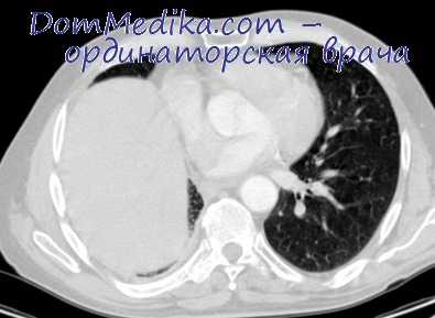 резекция легкого