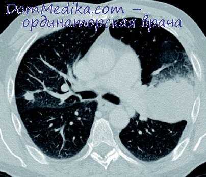 лобэктомия справа