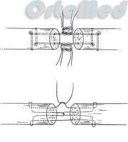 сухожилия сгибателей пальцев