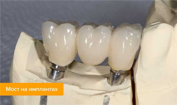 Фото моста на имплантах 