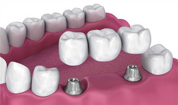 Несъемный протез на имплантах