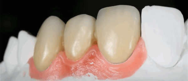 Изготовление металлокерамических протезов