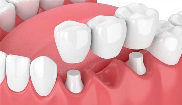 Методы и этапы установки мостовидных протезов