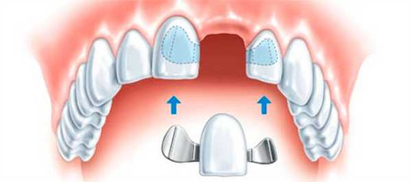 Установка адгезивных мостовидных протезов