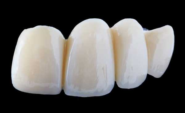 Фото керамического протеза