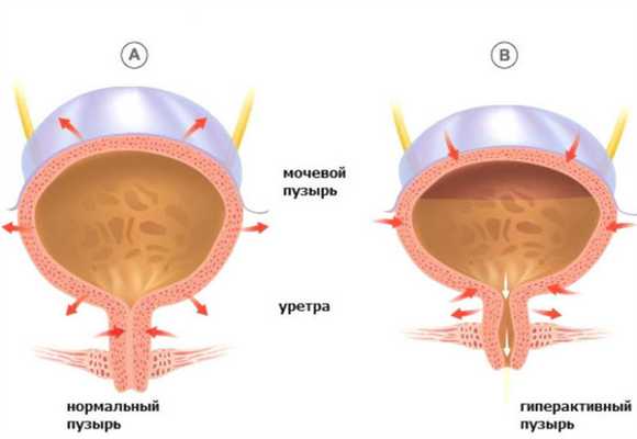 Недержание мочи