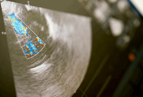 Эхокардиография и кардиомиопатии