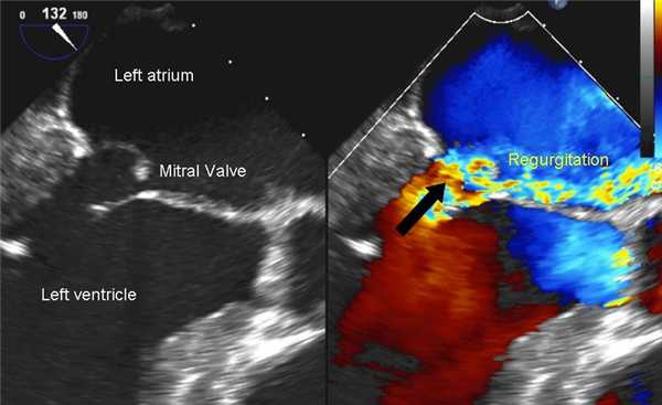 Митральная регургитация при ЭХОКГ