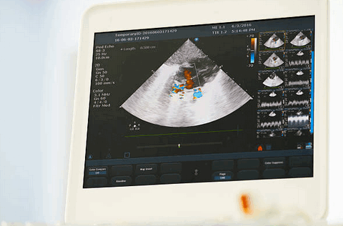 Эхокардиография при новообразованиях