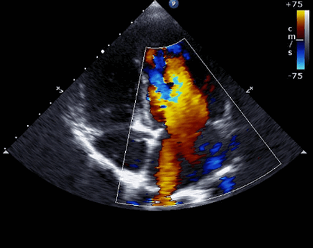 Гипертрофическая кардиомиопатия