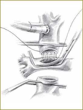 Рис. 1. Выполнение шва анастомоза между верхней полой веной и правой легочной артерией