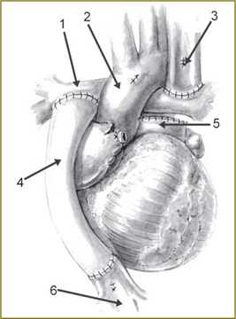  Операция Фонтена, выполненная с экстракардиальным кондуитом