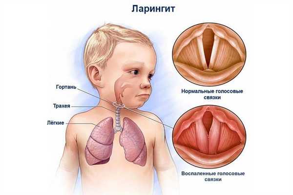 Воспаление при ларингите