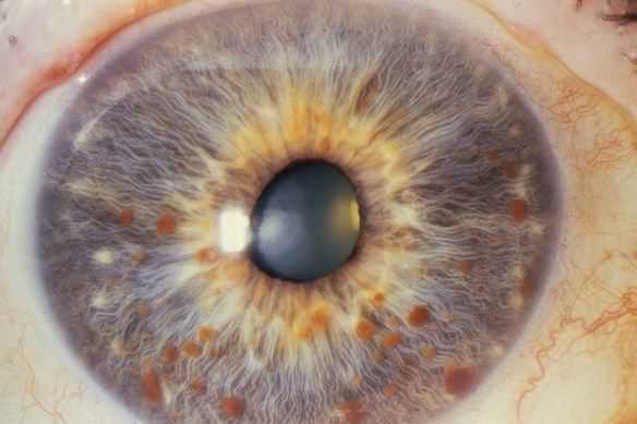 Гамартома радужки