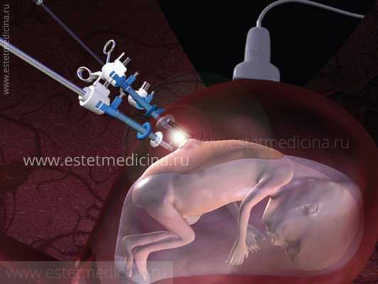 Фетоскопия