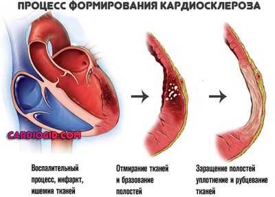 кардиосклероз
