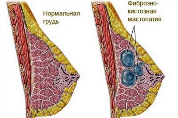Доброкачественная дисплазия молочной железы