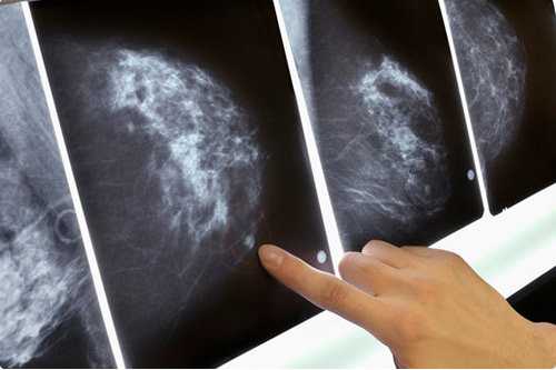 Диагностика фиброаденомы молочной железы