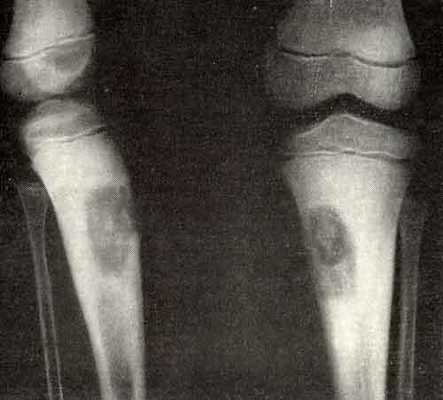 Диагностика фибромы