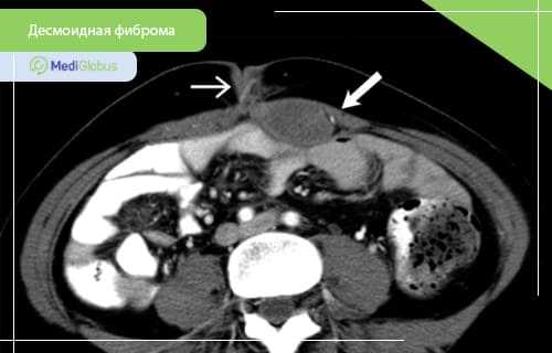 десмоидная фиброма фото